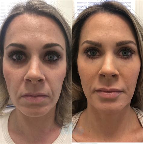 best botox in charlotte nc